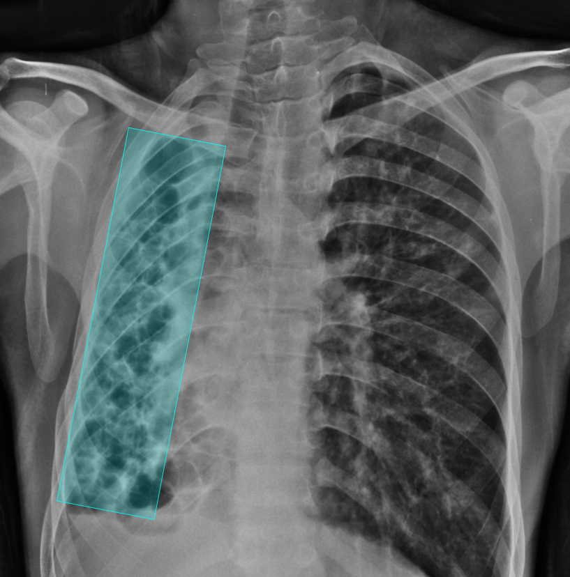 Chest X-ray with AI-detected Bronchiectasis highlighted