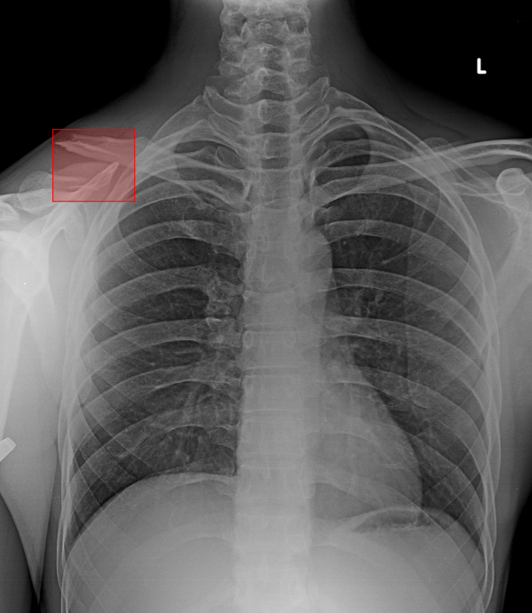 Chest X-ray with AI-detected Clavicle Fracture highlighted