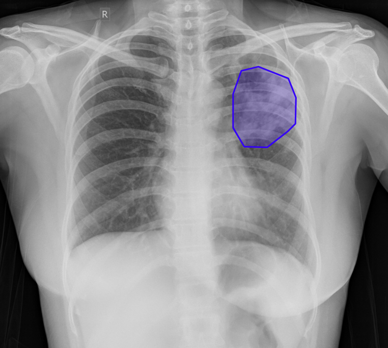 Chest X-ray with AI-detected Consolidation highlighted
