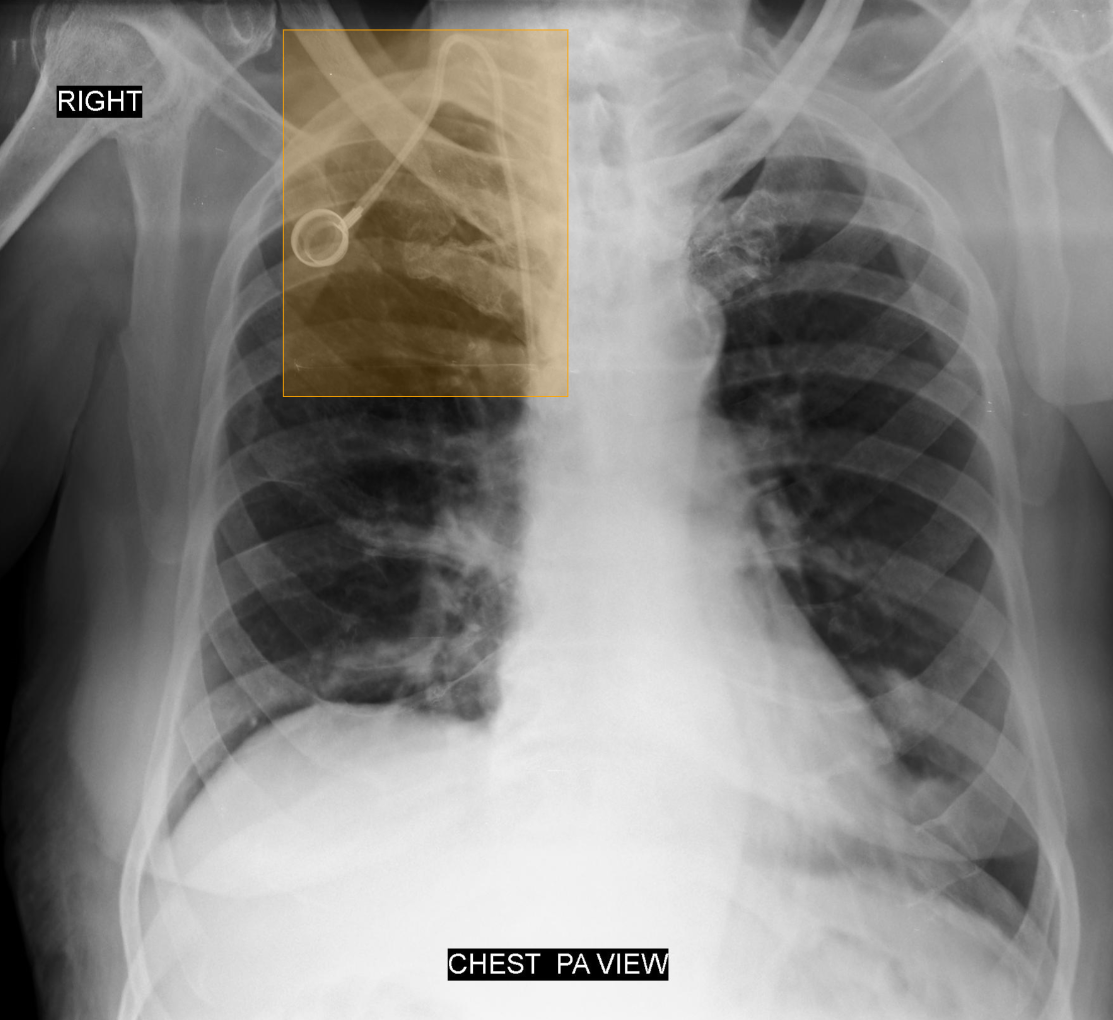Chest X-ray with AI-detected Foreign Body (Chemoport) highlighted