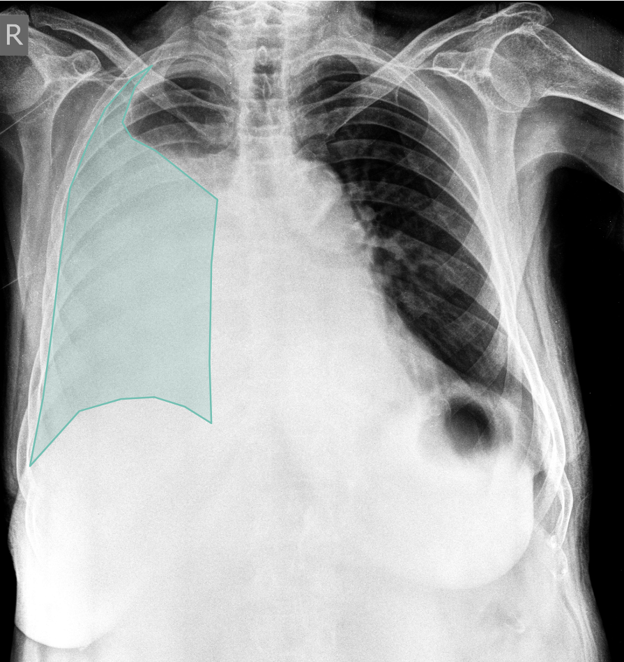 Chest X-ray with AI-detected Pleural Effusion highlighted