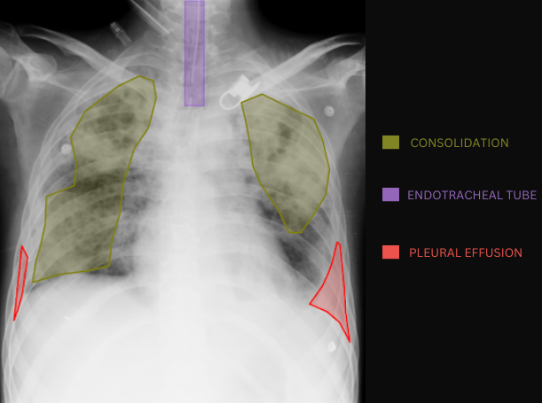 Chest X-ray with AI-detected pathology overlays showing consolidation, endotracheal tube, and pleural effusion annotations