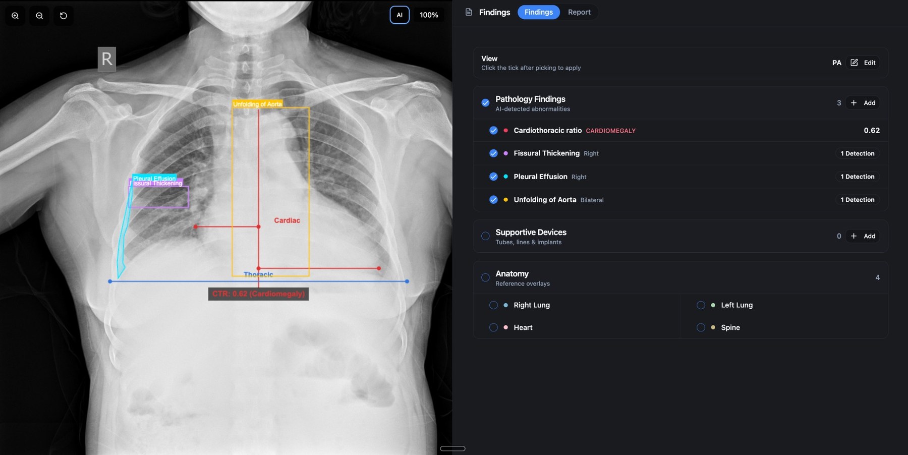 Cortex Rads-AI on a chest X-ray: AI-detected pathology findings including cardiomegaly, fissural thickening, pleural effusion, and unfolding of aorta.