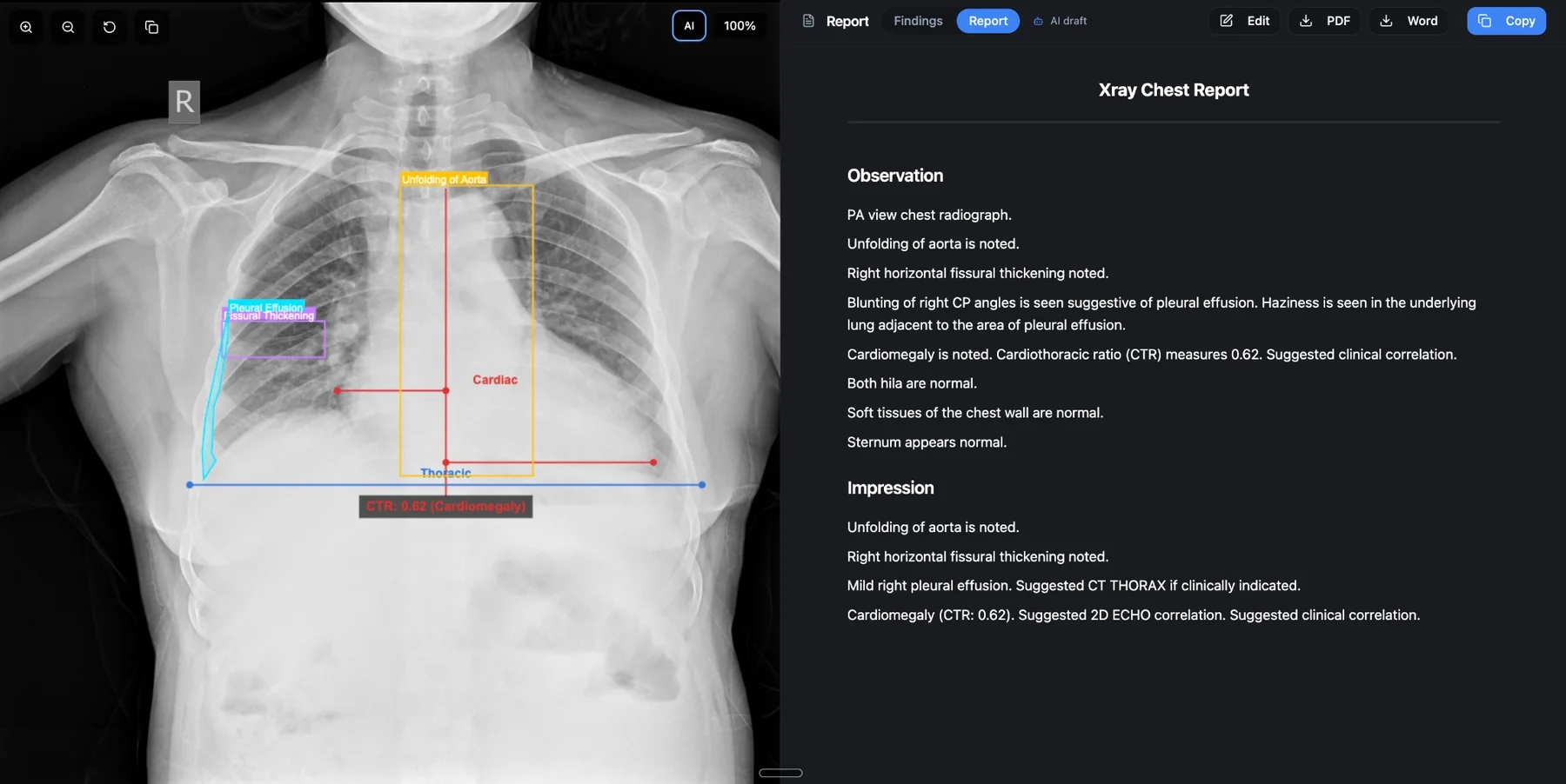 Bionic Vision on a chest X-ray: pleural effusion, fissural thickening and aortic unfolding outlined on the image, cardiothoracic ratio measured at 0.62, with the AI-drafted report beside it