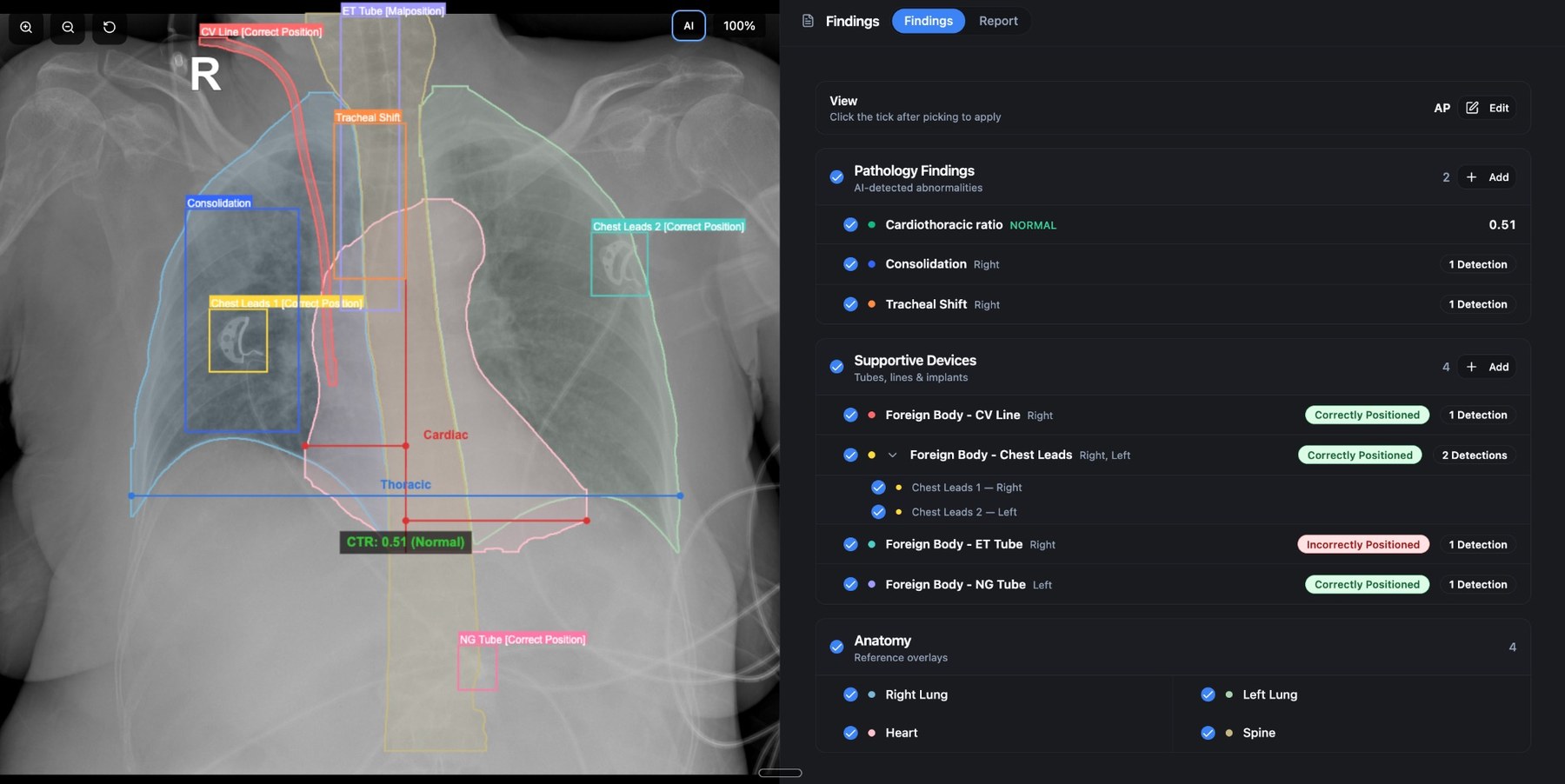 Cortex Rads-AI Supportive Devices view showing chest X-ray with ET tube, CV line, NG tube, and chest leads detected and labelled.